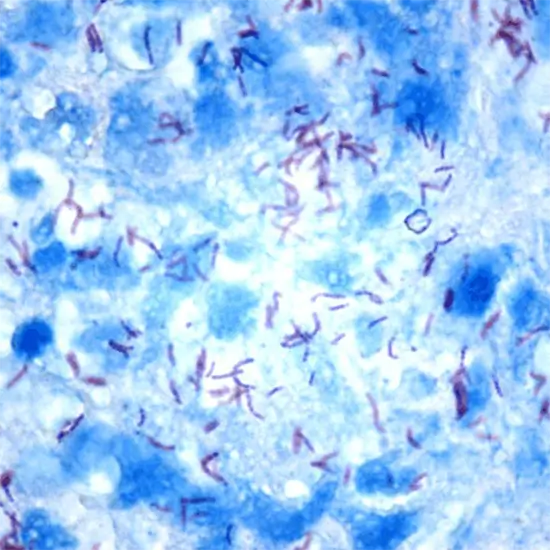Tuberculosis (TB) / Acid-Fast Bacillus (AFB) PCR